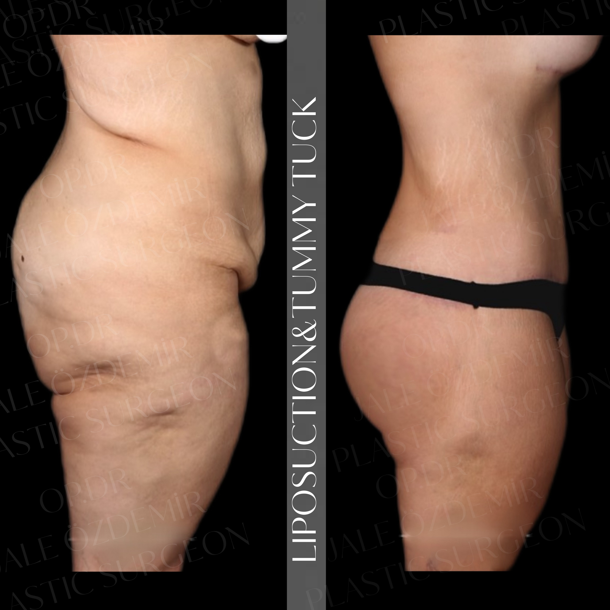 liposuction & bbl.png