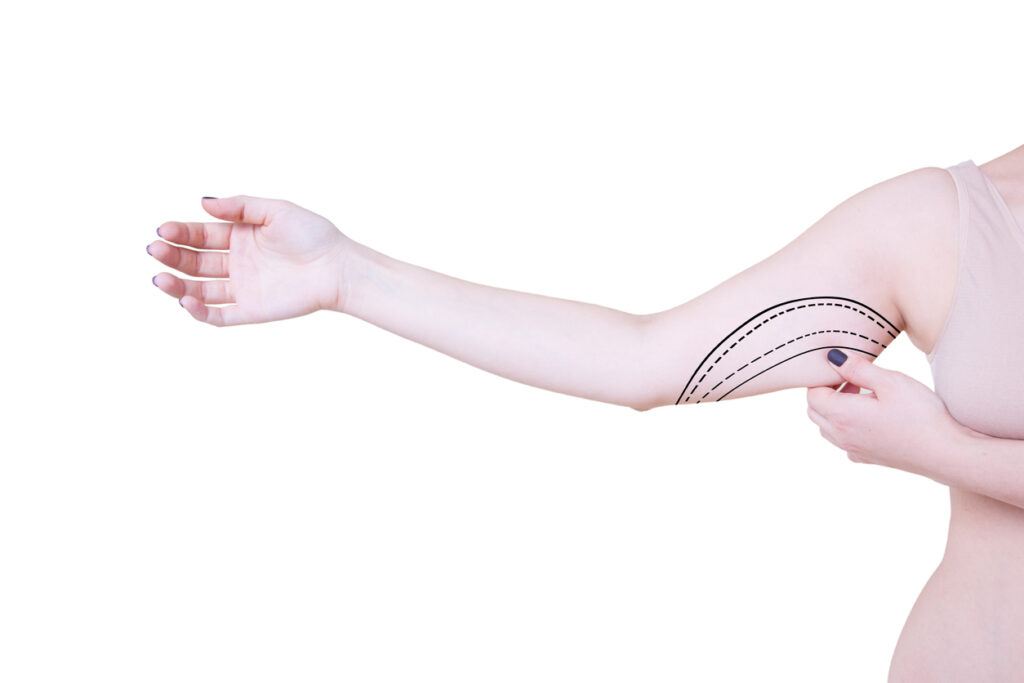 Arm Lift Surgery for Toned and Sculpted Arms – Dr. Jale Özdemir