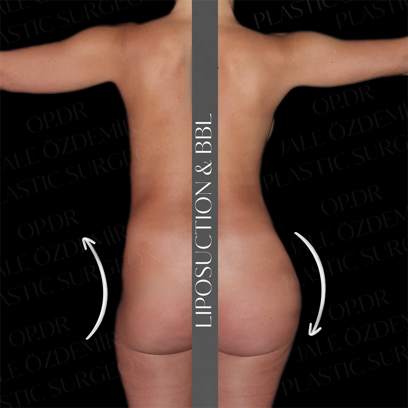 Op. Dr. Jale Özdemir BBL Liposuction