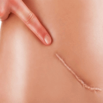 Op. Dr. Jale Özdemir Yara İzi Tedavisi