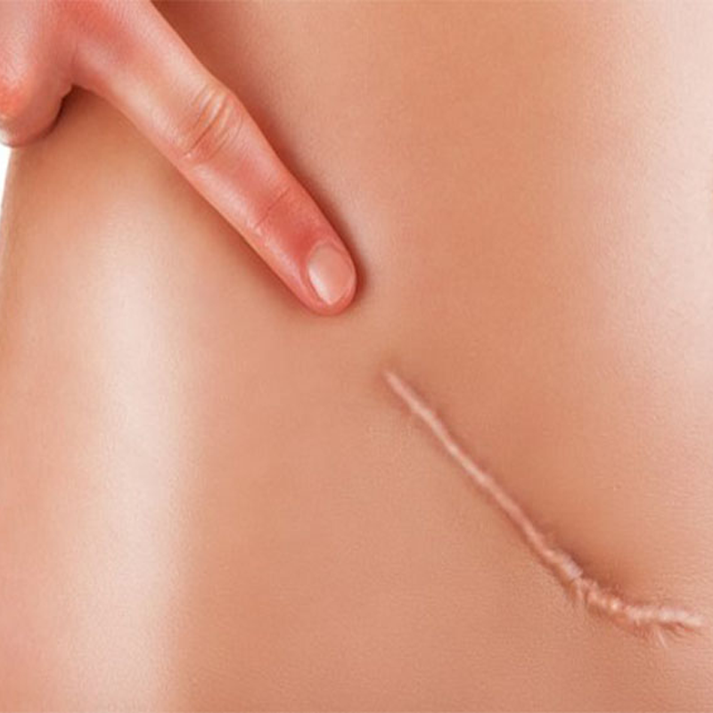 Op. Dr. Jale Özdemir Yara İzi Tedavisi